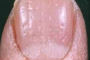 What are fingernail and toenail abnormalities?